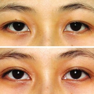 Double Eyelid Crease –In-fold Type